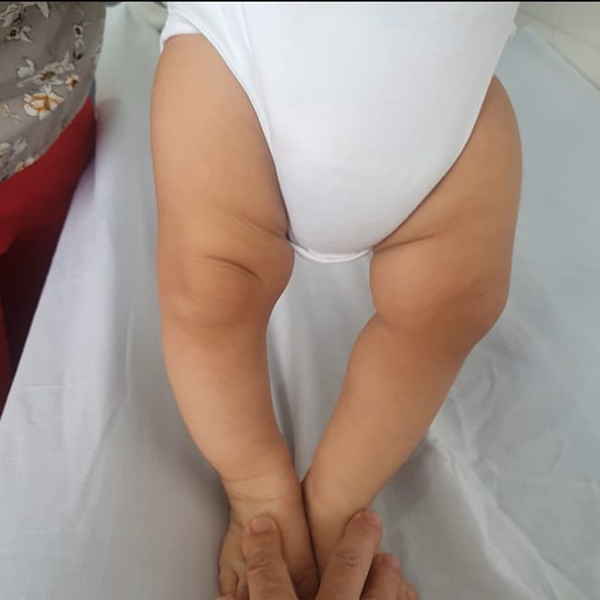 Genu Varo o piernas en paréntesis ¡Es frecuente en los lactantes!